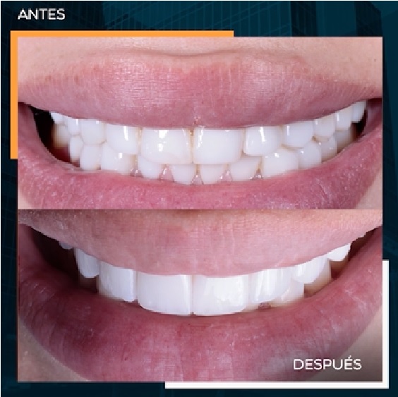 CASO5
